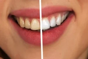denti